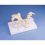 4-stage osteoarthritis (oa) shoulder model