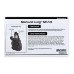 Lungenkrebs-Modell