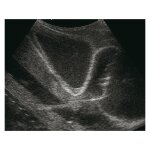 Simulator f&uuml;r Ultraschall-gest&uuml;tzte Perikardiozentese