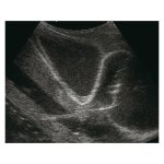 Ultrasound-Guided Pericardiocentesis Simulator