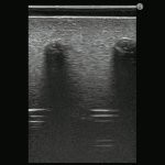 Ultrasound Compatible Lumbar Puncture / Epidural Simulator