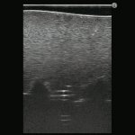 Ultraschallf&auml;higer Lumbalpunktions / Epiduralpunktions Simulator