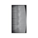 Lumbar Spine Fluoroscopy Training Phantom