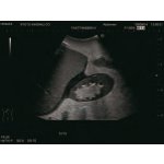 FAST Ultraschall Untersuchungsmodell