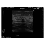 Breast Ultrasound Examination Phantom