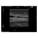 Breast Ultrasound Examination Phantom