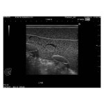 Breast Ultrasound Examination Phantom