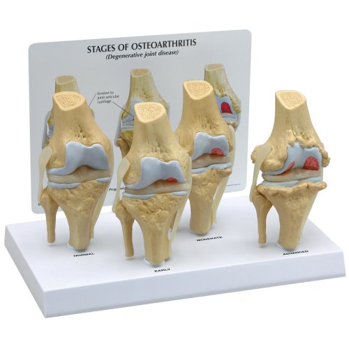 Osteo-Knie-Modell Set 4 verschiedener Stadien