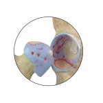 4-Stage Degenerative Bone Diseases of the Hip Model