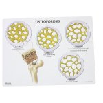 4-Stage Osteoporosis Hinged Disk Set