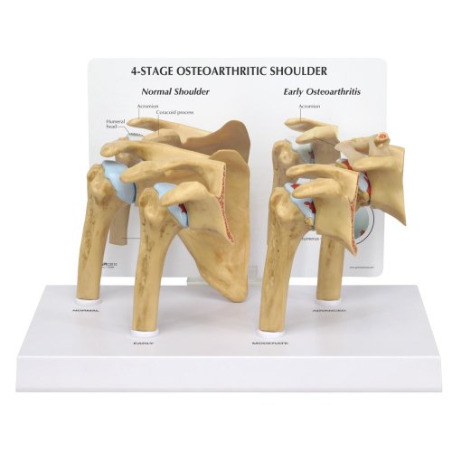 Osteoarthritis (OA) Schulter-Modell in 4 Stadien