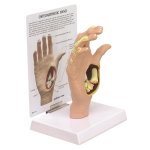 Hand-Modell mit Osteoarthritis