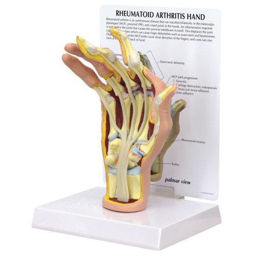 Hand-Modell mit rheumatoider Arthritis