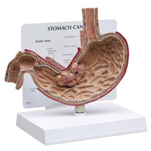 Stomach Cancer Model
