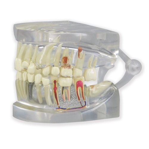 Durchsichtiger menschlicher Kiefer mit Zahn-Modell