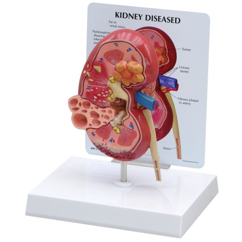Modell einer erkrankten Niere