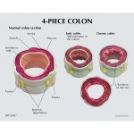 4-Piece Colon with Pathologies
