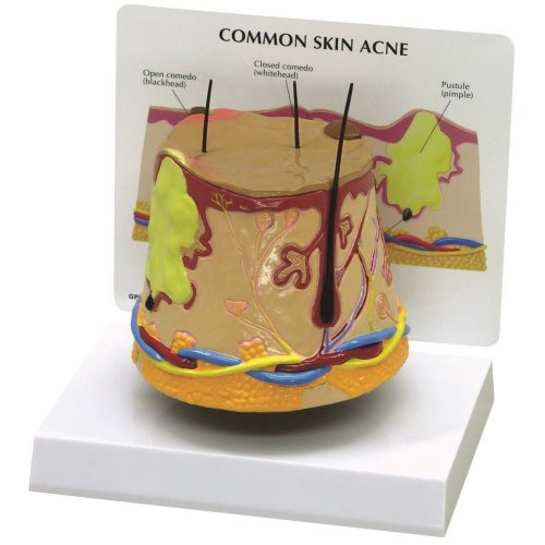 Skin Acne Model (oversize)