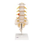 Lumbar Spine Model with Dorso-Lateral Prolapsed...
