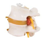 2 Lumbar Vertebrae with Prolapsed Disc, Flexibly Mounted - 3B Smart Anatomy