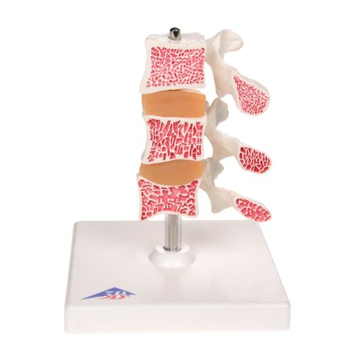 Osteoporose-Modell mit 3 Lendenwirbeln, auf Stativ - 3B Smart Anatomy