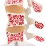 Osteoporosis Model (3 Vertebrae with Discs ), on Stand - 3B Smart Anatomy