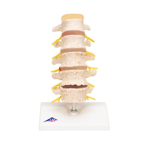 Stages of Disc Prolapse and Vertebral Degeneration Model - 3B Smart Anatomy