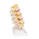 Stages of Disc Prolapse and Vertebral Degeneration Model - 3B Smart Anatomy
