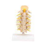 Stages of Disc Prolapse and Vertebral Degeneration Model - 3B Smart Anatomy