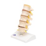 Stages of Disc Prolapse and Vertebral Degeneration Model - 3B Smart Anatomy