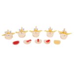 Stages of Disc Prolapse and Vertebral Degeneration Model - 3B Smart Anatomy