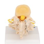 Stages of Disc Prolapse and Vertebral Degeneration Model - 3B Smart Anatomy