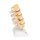 Stages of Disc Prolapse and Vertebral Degeneration Model - 3B Smart Anatomy