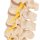 Stages of Disc Prolapse and Vertebral Degeneration Model - 3B Smart Anatomy