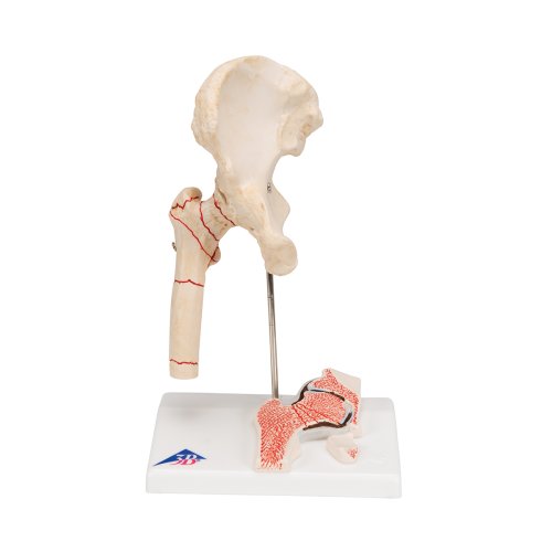 Hüftgelenk-Modell mit Oberschenkelbruch & Hüftgelenkverschleiß - 3B Smart Anatomy