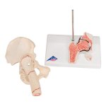 H&uuml;ftgelenk-Modell mit Oberschenkelbruch &amp; H&uuml;ftgelenkverschlei&szlig; - 3B Smart Anatomy