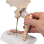 Femoral Fracture &amp; Hip Osteoarthritis Model - 3B Smart Anatomy