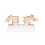 Osteoporosis Didactic Model - 3B Smart Anatomy