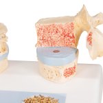 Osteoporose-Modell des 11. und 12. Brustwirbels - 3B Smart Anatomy