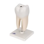 Lower Twin-Root Molar with Cavities Tooth Model, 2 part - 3B Smart Anatomy