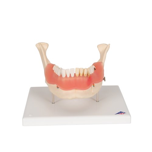 Dental Disease Model, 2x magnified, 21 parts - 3B Smart Anatomy