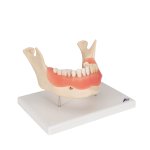 Dental Disease Model, 2x magnified, 21 parts - 3B Smart Anatomy