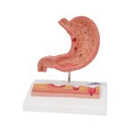 Magen-Modell mit Magengeschwüren - 3B Smart Anatomy