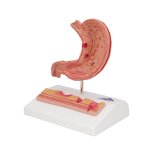 Stomach Section Model with Ulcers - 3B Smart Anatomy