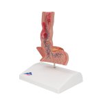 Pathologisches Speiseröhren-Modell - 3B Smart Anatomy
