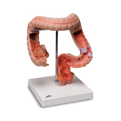 Pathologisches Darm-Modell - 3B Smart Anatomy