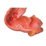 Pathologisches Darm-Modell - 3B Smart Anatomy