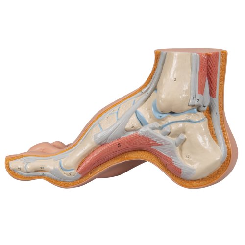 Hollow Foot (Pes Cavus) Model - 3B Smart Anatomy