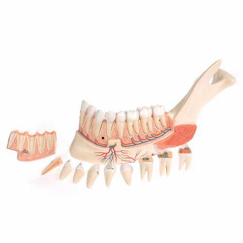 Lower Jaw Model (Left Half) with Diseased Teeth, Nerves, Vessels & Glands, 19 part - 3B Smart Anatomy