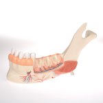 Unterkieferhälfte-Modell mit 8 kariösen Zähnen, 19-tlg - 3B Smart Anatomy